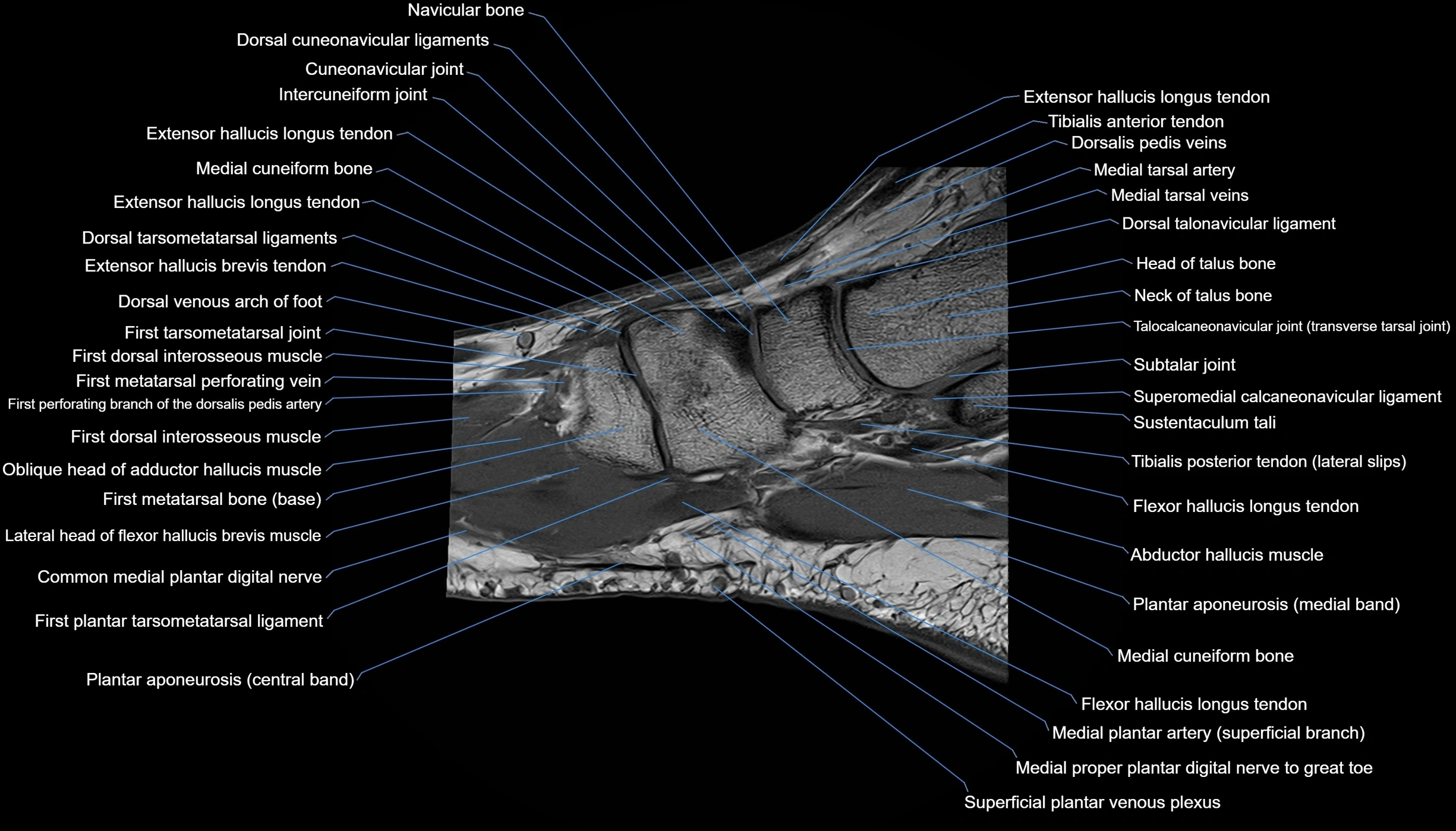 MRI mid foot sagittal cross sectional anatomy 3T  radiology  image-img-00001-00029.webp